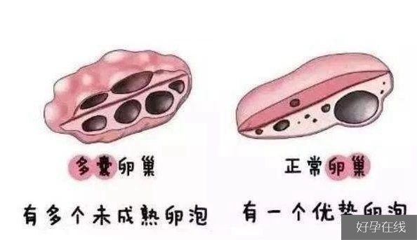 多囊卵巢与正常卵巢的区别