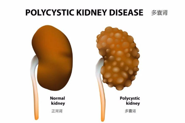 多囊肾