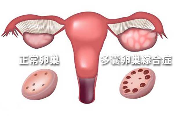 多囊卵巢的症状