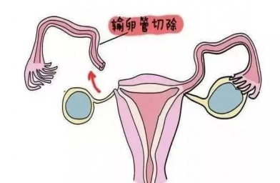 慈铭博鳌国际医院三代试管婴儿，切除双侧输卵管还能做试管婴儿吗？